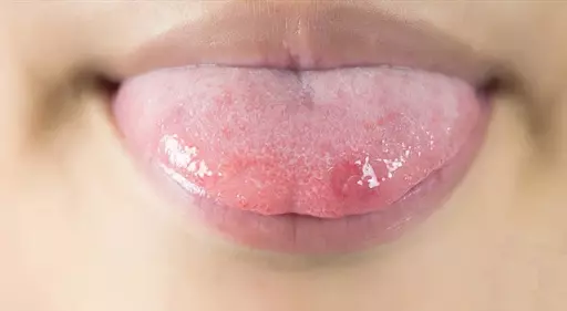 [Xem ngay] Nhiệt miệng ở lưỡi và cách điều trị hiệu quả 